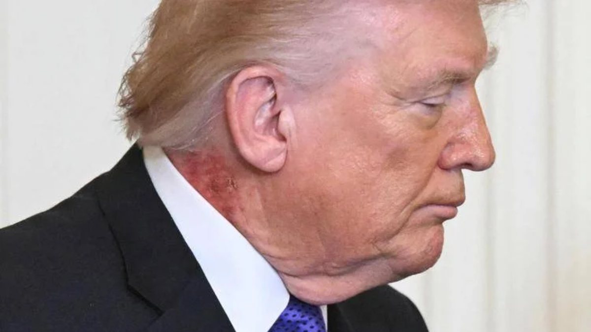 trump con il collo rosso la foto scatena i dubbi sulla sua salute da Thesocialpost.it trump con il collo rosso la foto scatena i dubbi sulla sua salute