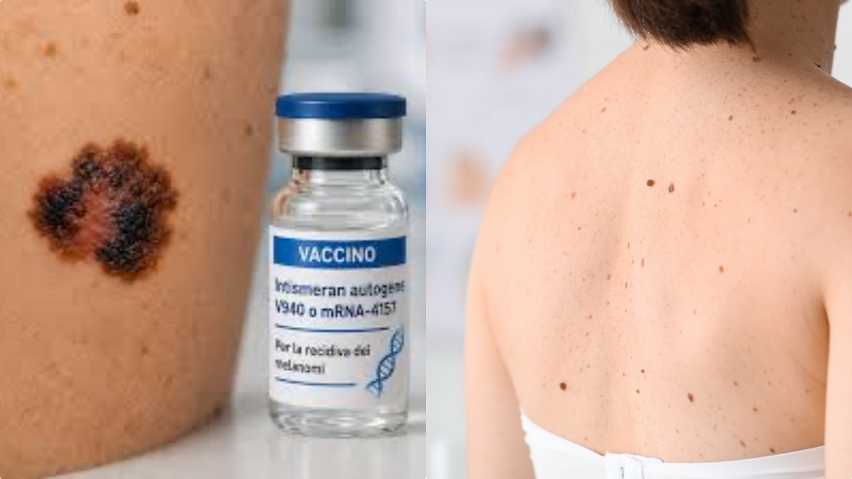Cancro della pelle, la scoperta rivoluzionaria: vaccino a mRNA efficace in studio di Fase 3