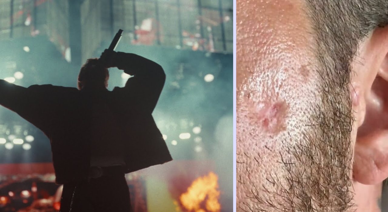 “Ho il cancro alla pelle, colpa delle creme solari”. Il famoso cantante italiano sconvolge tutti e scoppia la polemica